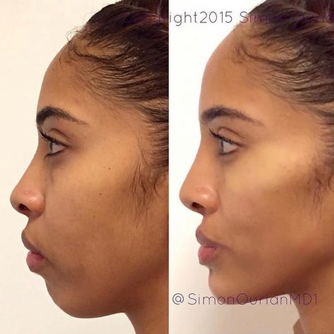 Dr. Simon Ourian - Epione sur Instagram : « Nonsurgical cheek & chin augmentation. Before (left) and after (right) of nonsurgical cheek lift and augmentation plus chin… » Rhinoplasty Recovery, Chin Filler, Vicki Gunvalson, Chin Augmentation, Chin Implant, Cheek Lift, Face Fillers, Hair Implants, Cheek Fillers