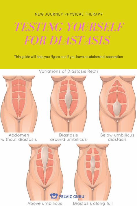 Diastasis Recti Looks Like, How To Check For Diastasis Recti, How Do You Know If You Have Diastasis Recti, How To Fix Diastasis Recti Years Later, Correcting Diastasis Recti, Severe Diastasis Recti, How To Avoid Diastasis Recti, Diastis Recti Before And After, Ab Separation Diastasis Recti Exercise