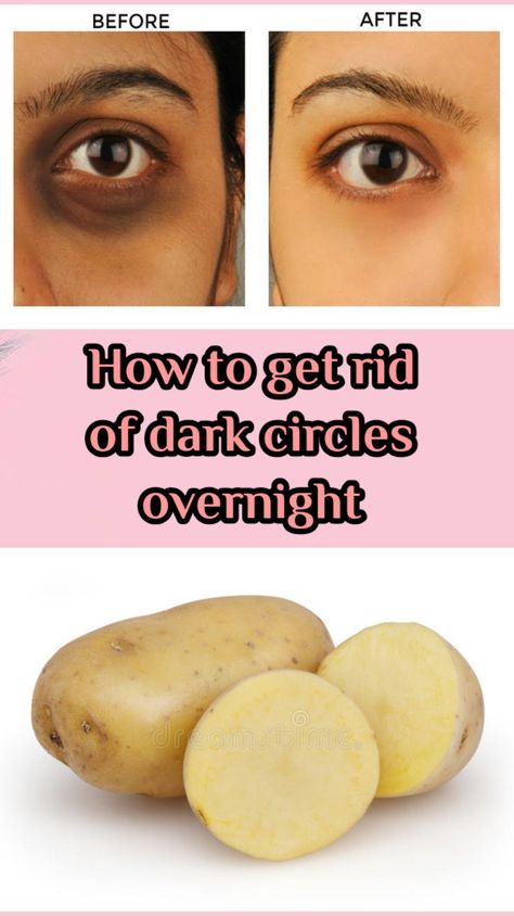 Get Rid of Dark Circles at Home Potato For Dark Circles, Dark Circle Remedies Overnight, Gallbladder Removal, Dark Circle Remedies, Dark Circles Around Eyes, Brown Spots On Skin, Dark Eye Circles, Dark Spots On Face, Brown Spots Removal