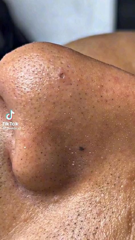 #RemediesForCold How To Prevent Blackheads, Pimple Removal, Pimple Free Skin, Clear Smooth Skin, Remove Blackheads From Nose, Clear Blackheads, To Remove Blackheads, Acne Removal, Satisfying Stuff