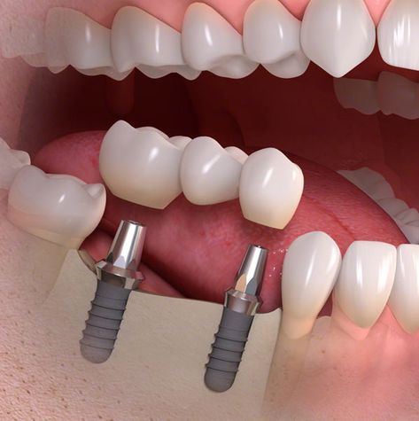 Dental Images, Dental Posters, Best Dental Implants, Dental Implants Cost, Oral Surgeon, Small Wedding Cakes, Implant Dentistry, Teeth Implants, Dental Bridge