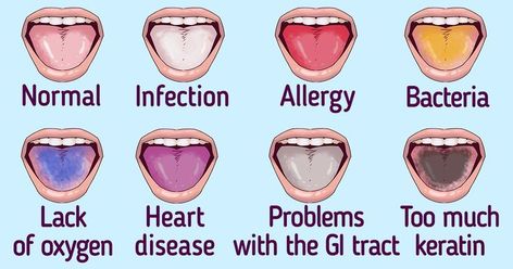 Yellow Tongue, Healthy Tongue, Vitamin B Deficiency, Human Tongue, Black Tongue, Tongue Health, Feminine Health, Gum Health, Heart Problems