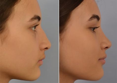 Nose Hump Aesthetic, Dorsal Hump Nose Pretty, Dorsal Hump Nose, Hump Nose, Nasal Surgery, Rhinoplasty For Bulbous Nose, Closed Rhinoplasty, Wide Bridge Nose Rhinoplasty, Dorsal Hump Rhinoplasty