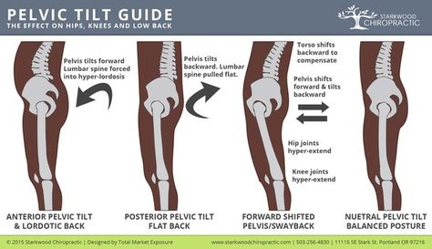 Tilted Pelvis Symptoms, Rotated Pelvis, Tilted Pelvis, K Tape, Psoas Release, Posture Fix, Pelvic Tilt, Psoas Muscle, Hip Flexors