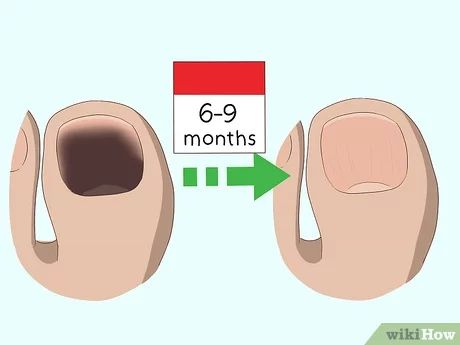 Dark Toe Nails Remedy, Thick Toenail Remedy, Dark Toenails, Brown Toe Nails, Black Spot On Toenail, White Spots On Toenails, Black Toenail Fungus, Toenail Problems, Toenail Health