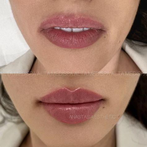 Fillers | Flat Lips | Morpheus8 | London | Beautiful lips in our Signature Technique done by Anastasia What was done? ✔️Corrected downturned corners ✔️Improved Volume ✔️Lifted the… | Instagram Flat Lips Filler, Bigger Top Lip Filler, Vermillion Border Lip Filler, Lip Filler M Shaped Lips, 1.5 Ml Lip Filler, .5 Syringe Lip Filler, Pink Body, Lip Fillers, Beautiful Lips