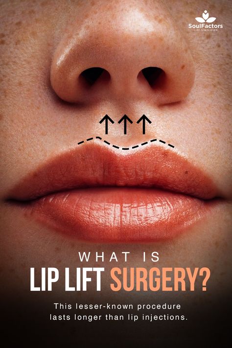 Lip Implants Before And After, Lip Surgery Before And After, Lip Lift Surgery Before And After, Lip Augmentation Before And After, Lip Threading Before And After, Lip Lift Before And After, Lips Surgery, Lip Filler Before And After, Lip Lift Surgery