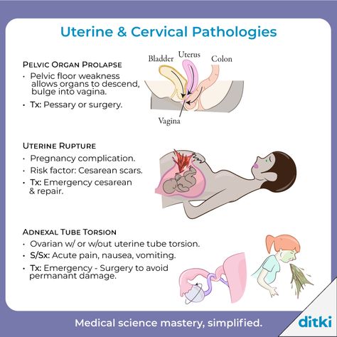 A glimpse of our Uterine & Cervical Pathologies tutorial - see more: https://ditki.com/course/pathology/reproductive-pathologies/uterine-ovarian-pathologies/2024/cervical-uterine-pathologies---nonneoplasms   #ditki #usmle #meded #medschool #medstudent #highered #mededonline #usmletutorials #nursepractitioner #nursing #pance #physicianassistant #osteopath #allopath #medicine #science #healthscience #nurse #premed #mcat #mbbs Clinical Pathology, Uterine Polyps, Urinary Bladder, Pelvic Muscles, Medical Study, Cesarean Delivery, Lymph Vessels, The Menstrual Cycle, Pelvic Organ Prolapse