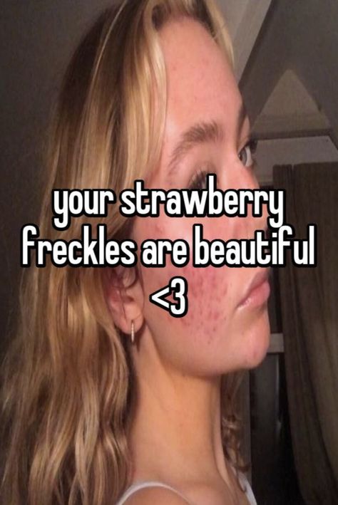 Acne Is Beautiful Quotes, Pretty With Acne, Normalizing Insecurities, Acne Positivity Quotes, Acne Is Beautiful, Pretty People With Acne, Acne Quotes, Strawberry Freckles, Acne Positivity