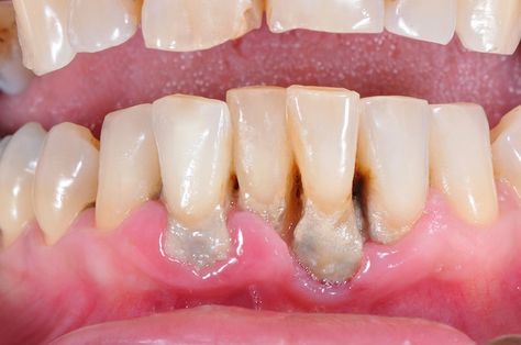 Dental Health Care, Oral Surgeon, Teeth Health, How To Prevent Cavities, Periodontal Disease, Receding Gums, Gum Health, Teeth Care, Cosmetic Dentistry