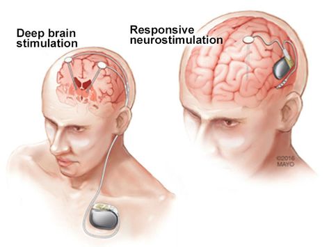 Neurology Nursing, Artificial Heart, Essential Tremors, Pie Graph, Deep Brain Stimulation, Arduino Cnc, Medical Tech, Medical Videos, Brain Stimulation