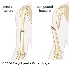 Research shows smoking harms your chances of recovering from fractures. Bone healing cells in non-smokers are of a better quality, more active and quicker at dividing than those of smokers, according to new research carried out by United Lincolnshire Hospitals NHS Trust (ULHT) and the University of Lincoln, UK, Open Fracture, Types Of Fractures, Fracture Healing, Bone Drawing, Femur Bone, Bone Healing, Types Of Bones, Bone Fracture, To The Bone