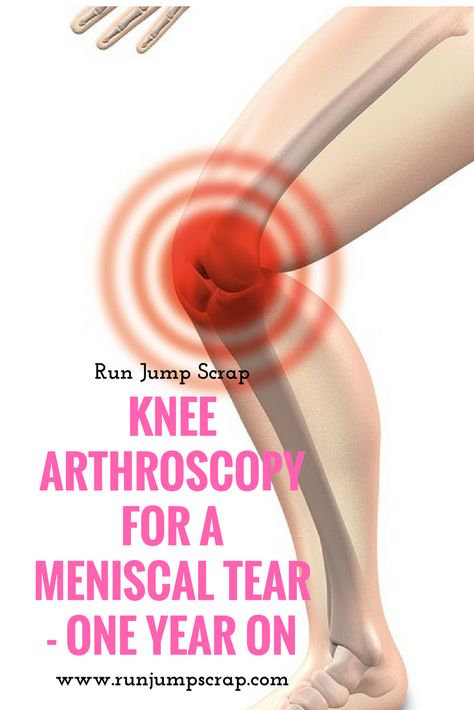 Knee Arthroscopy for a Meniscal Tear - One Year On - Run Jump Scrap! How I have got on after knee surgery, my physio and rehab. #knee #health Meniscus Repair Surgery Recovery, Meniscus Rehab Exercises After Surgery, Meniscus Surgery Recovery, Pt After Meniscus Surgery, Knee Exercises After Meniscus Surgery, Exercises For Knee Replacement Patients, Knee Ligament Tear Exercises, Recovering From Knee Replacement Surgery, Arthroscopic Knee Surgery