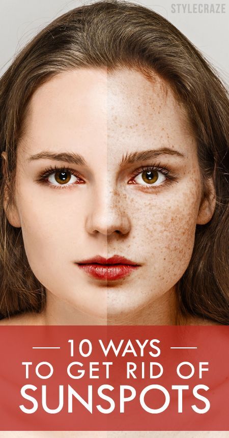 Sun Damage On Face, Black Spots On Face, Sun Spots On Face, Sunspots On Face, Sun Spots On Skin, Brown Spots On Hands, Brown Age Spots, Brown Spots On Skin, Spots On Skin