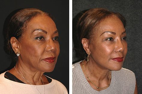 african american facelift before and after Facelift Before And After, Facelift Surgery, Acanthosis Nigricans, Sagging Cheeks, Facelift Procedure, Facial Aging, Face Lift Surgery, Try Try, Nasolabial Folds