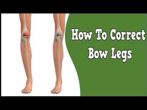 #Badposturefix How To Correct Bow Leg, Leg Straightening Exercise, How To Have Long Legs Exercise, Bow Legs Correction Exercise, Ugly Legs, Genu Varum, Knee Fat, Bow Legged Correction, Posture Fix