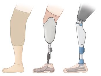 For the individuals who have prostheses for more everyday uses, however, their substitution limbs should be capable adjust to various situations and play out an assortment of functions, not simply excel in one discipline – Prosthetic leg meaning just like an actual leg. At Rinella Prosthetics, modern running edges have a particular snare shape, one of the most encouraging engineering approaches for regular prostheses is to closely model the biological design of a leg, lower leg, and foot. Leg Prosthesis Art, Prosthetic Leg Types, Metal Prosthetic Leg, Prostethics Leg Drawing, Prostethics Leg, Prosthetic Leg Design, Robotic Prosthetics, Leg Prosthesis, Leg Reference