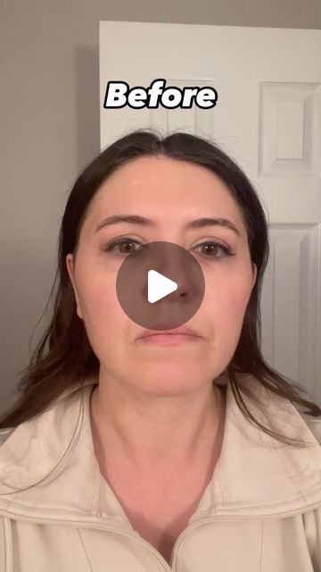 6 likes, 2 comments - dr.jessicaburgy on March 27, 2024: "My before and after photos from laser resurfacing! 💫 I love the results and plan on doing this once a year to keep my skin glowing....". Laser Skin Resurfacing, Laser Resurfacing, Skin Resurfacing, Skin Glowing, Laser Skin, Laser Therapy, March 27, After Photos, My Skin