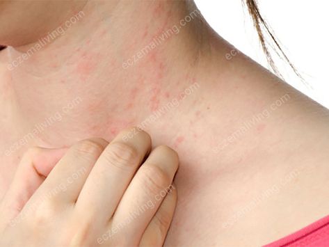 Eczema On Neck - How To Get Rid of Neck Eczema? Alcohol Intolerance, Color Of Urine, Rash On Neck, Heat Rash, Itching Skin, Allergy Symptoms, Dr Oz, Abdominal Pain, Skin Conditions