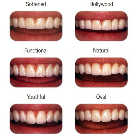 Cosmetic Dentistry - Los Angeles Cosmetic Dentistry - Culver City Cosmetic Dentistry - Centurysmile.com Teeth Makeover, Dental Makeover, Cosmetic Dentistry Veneers, Cosmetic Dentistry Procedures, Teeth Whitening Homemade, Veneers Teeth, Beautiful Teeth, Perfect Teeth, Dental Veneers