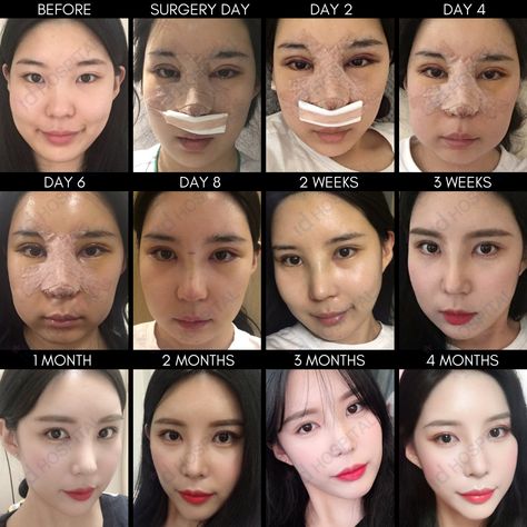 Double Eyelids Korean, Korean Nose Job, Korean Nose, Korean Surgery, Plastic Surgery Korea, Eyes Bigger, Korean Plastic Surgery, Facial Contouring, Double Eyelid