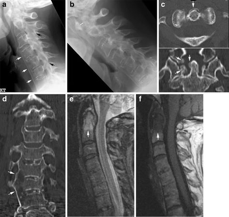 Imaging the spine in arthritis—a pictorial review | Insights into Imaging | Full Text Cervical Spine, Spinal Cord, Neck Pain, Medical