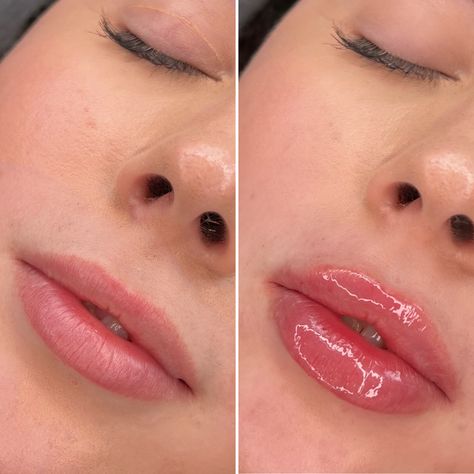 Lip Fillers 1ml, 1 Ml Lip Filler, Lip Fillers Before And After 1ml, 1ml Lip Filler, Lip Goals, Dream Lips, Lip Augmentation, Lip Filler, Lip Enhancement