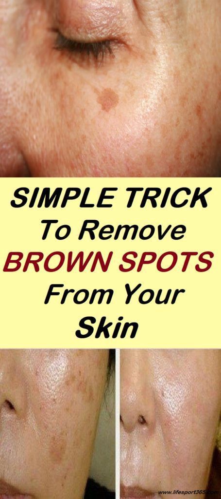 Sun Damage On Face, Sun Spots On Face, Sunspots On Face, Sun Spots On Skin, Spots On Forehead, Brown Spots On Hands, Brown Age Spots, Age Spot Removal, Spots On Skin