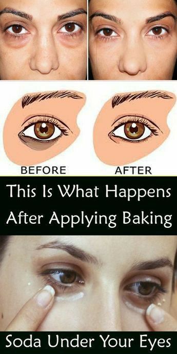 Baking Soda Under Eyes, Puffy Eyes Remedy, Baggy Eyes, Hooded Eyelids, Baking Soda And Lemon, Teeth Whitener, Dark Eye Circles, Eye Natural, Tips For Glowing Skin