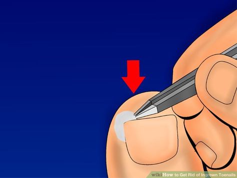 3 Ways to Get Rid of Ingrown Toenails - wikiHow Toenail Fungus Essential Oils, Infected Ingrown Hair, Ingrown Toenail, Ingrown Nail, Prevent Ingrown Hairs, Ingrown Toe Nail, Toenail Fungus, Hair Essentials, Nail Fungus