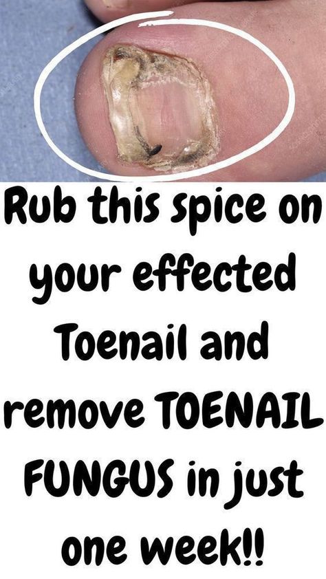 Toe Nail Fungal Infection Infected Toenail, Toenail Fungal Infection, Toenail Fungus Remedies, Nail Fungus Remedy, Fungal Nail, Toenail Fungus, Fungal Infection, Nail Fungus, Me Time