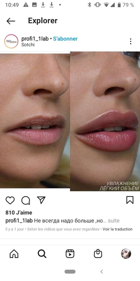 Lip Goals Filler, Lip Filler For Hydration, Downturned Lips Filler, Lip Filler Inspo Heart Shape, .5ml Vs 1ml Lip Filler, Lip Filler Shape Ideas 1ml, Bow Shaped Lip Filler, Lip Filler 1 Syringe, Heart Shaped Lip Filler