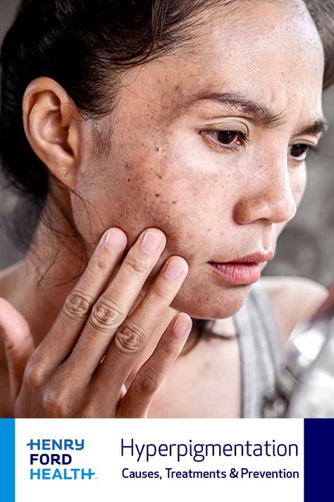 Hyperpigmentation, or discoloration of the skin, can be tricky to deal with. It can be caused by a variety of factors, from pregnancy hormones and birth control pills to acne and sun exposure. A plastic surgeon discusses causes, treatments and prevention. Age Spot Removal, Calorie Workout, Chemical Peels, Skin Hyperpigmentation, Brown Spots Removal, Up Dos For Medium Hair, Saggy Skin, Makeup For Green Eyes, Age Spots