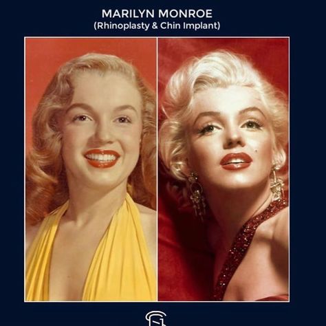 Jessica Manges ARNP Aesthetic on Instagram: “Marilyn Monroe had a rhinoplasty and chin implant which gave her the iconic look we remember her today by. Beauty icons throughout history…” Chin Implant Before And After, Marilyn Monroe Plastic Surgery, Chin Implant, Facial Plastic Surgery, Facial Aesthetics, Celebrity Plastic Surgery, Reconstructive Surgery, Facial Plastic, Nose Job