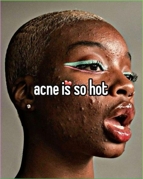 pretty sure the bg is @nazhaya || #acne #pimple #whisper #fyp #skibidi Acne Overnight, Remove Acne, Baking Soda, Beauty Hacks, Acne, Baking, Beauty