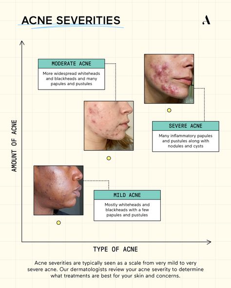 Wondering what the differences are between mild acne, moderate acne, and severe acne? We're breaking down the differences in our acne severities Slather article. Read more about treating mild, moderate, and severe acne. Types Of Acne And Causes, What Different Areas Of Acne Mean, Rash On Hands, Skin Knowledge, Acne Awareness Month, Skincare Illustration, Active Acne Remedies, Skincare Education, Acne Medication