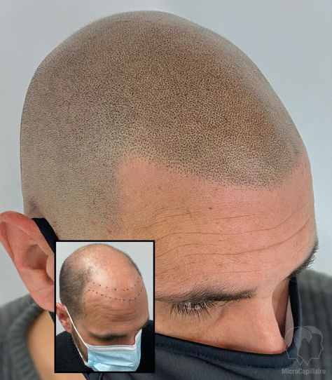 Scalp micropigmentation clinic in Montreal & Laval, Canada, cosmetic tattoo, hair loss solution. Head Tattoo Hair, Scalp Micropigmentation Women, Hair Tattoo Men, Micro Scalp Pigmentation, Hair Pigmentation, Hairline Tattoos, Balding Mens Hairstyles, Scalp Tattoo, Bald Men Style