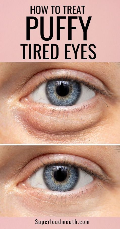 Eye Bag Remedies, Puffy Eyes Remedy, Baggy Eyes, Swollen Eyes, Skin Care Wrinkles, Under Eye Bags, Beauty Remedies, Tired Eyes, Looks Black