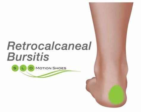 Heel Bursitis Exercises, Achilles Bursitis Exercises, Retrocalcaneal Bursitis, Achilles Bursitis, Heel Bursitis, Achilles Pain, Shoulder Impingement, Calf Exercises, Heel Pain Relief