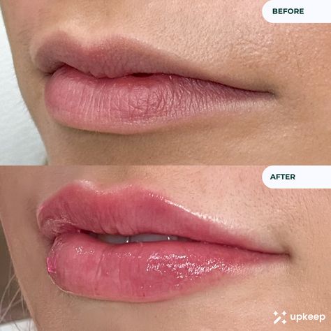 Lip Filler Before & After! One full syringe of lip filler #BookedOnUpkeep 🪄 Download the Upkeep app now to start searching for vetted medical aesthetic treatments near you! Available on iOS & Google Play! 👄 # 1ml lip filler Botox lips Lips inspiration Natural lips Restylane lips Natural Shape Ideas Lip Shapes Lip Aesthetic plump lips lip filler inspo lip injections before and after lip filler shape ideas lip filler inspiration lip fillers lip filler inspo Lip Filler On Full Lips, Lip Flip Vs Filler, Natural Lip Fillers Before And After, Half Syringe Lip Filler Before And After, 1 Ml Lip Filler Before And After, Lip Filler Natural, Lip Fillers Before And After 1ml, 0.5 Ml Lip Filler Before And After, Lip Filler Shape Ideas