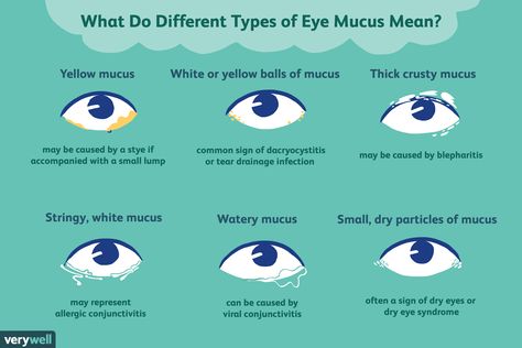 Pink Eye In Toddlers, Goopy Eyes, Crusty Eyes, Yellow Mucus, Dry Sinuses, Different Types Of Eyes, Severe Cough, Sinus Allergies, Diy Medicine