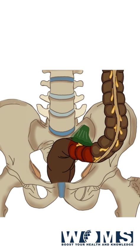 The sigmoid colon is also known as the pelvic colon due to its presence in the pelvic region. It is the last part of the large intestine nearest to the rectum and anus. It is the point where feces stays for a while before getting excreted. The sigmoid colon maintains a continuation from the descending colon to the rectum. It is usually present within the pelvis area. But, it often becomes displaced into the abdominal cavity due to its mobility. Colon Anatomy, Sigmoid Colon, Pelvic Region, Large Intestine, Anatomy, Mario Characters, Zelda Characters, Fictional Characters