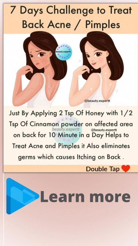 How To Get Rid Of A Blind Pimple Under The Skin - DocPe How To Get Rid Of A Blind Pimple Under The Skin Home Made Remedies For Pimples, Acne And Pimples Home Remedies, How To Treat Acne At Home, Honey On Pimples, Pimple Under The Skin, How To Treat Pimples, Back Acne Causes, Skincare Blackheads, 7 Days Challenge