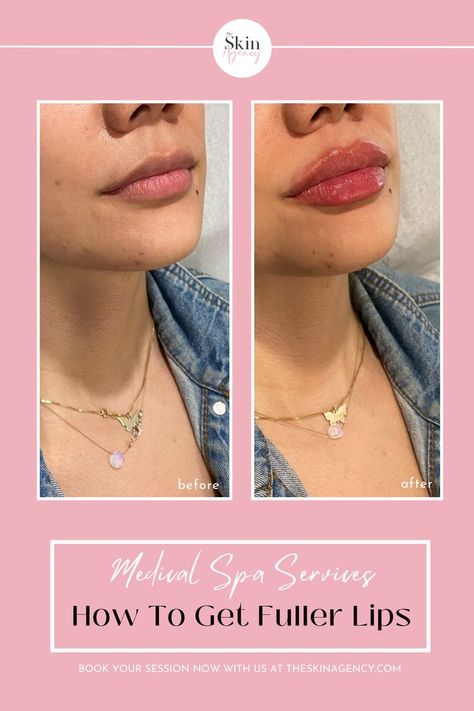 Achieving fuller lips with lip fillers is a popular cosmetic trend. Lip filler before and after pictures show the amazing transformation possible. From subtle tweaks to dramatic changes, lip filler shape ideas and inspiration can help you achieve the look you desire. Book an appoitment with the skin agency to discuss your options and achieve your perfect pout. #medicalspa #losangelesbeauty #facialtreatments #lipfillers Lip Filler Shape Ideas, Lips Inspiration, Shape Ideas, Fuller Lips, Facial Fillers, Lip Filler, Full Lips, After Pictures, Medical Spa