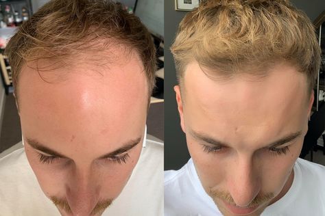 There was a time when the fight against hair loss was an uphill battle, and men would surrender to balding. But before you reach for the razor or hide your head under a hat, it’s worth considering the options. Below are three real-life stories of […]Visit Man of Many for the full post. Hair Lossing Tips Men, Thinning Hair Men, Mens Hair Regrowth, Balding Mens Hairstyles, Short Hair Outfits, High Forehead, Receding Hair Styles, Hair Issues, Male Pattern Baldness