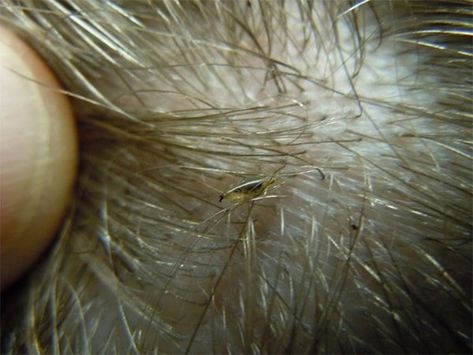 Lice eggs (nits) are tiny eggs that will later hatch into lice. To treat head lice completely off, in addition to catching and killing all lice, removing egg lice is also extremely necessary. Removing eggs will not only prevent pain for those who are having to suffer this annoying situation, but also Blonde Hair Pictures, How To Treat Lice, Lice Nits, Hair Lice, Lice Eggs, Head Louse, Hair Pictures, About Hair, Behind Ear Tattoo