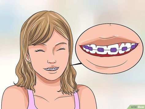 Dental Braces Colors, Braces Colors Combinations, Braces Colors Ideas, Braces Bands, Braces Cost, Cute Braces Colors, Braces Tips, Getting Braces, Health Aesthetic