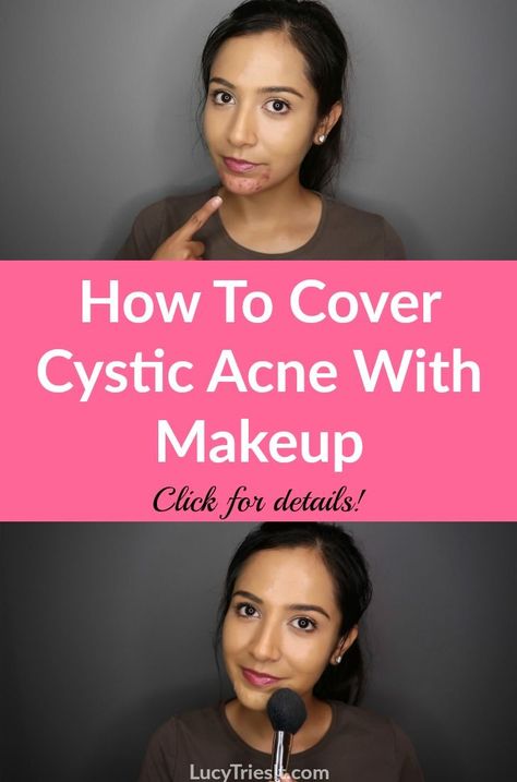 Cystic acne can be very frustrating. Luckily, there is an effective way to cover cystic acne with makeup and I'm going to show you how! #makeup #acne #acnesolutions #cysticacne #acnemakeup Makeup With Acne Showing, Acne With Makeup, Covering Acne With Makeup, Cystic Acne On Chin, Makeup Acne, Treating Cystic Acne, Cystic Acne Remedies, Acne Makeup, Prevent Pimples