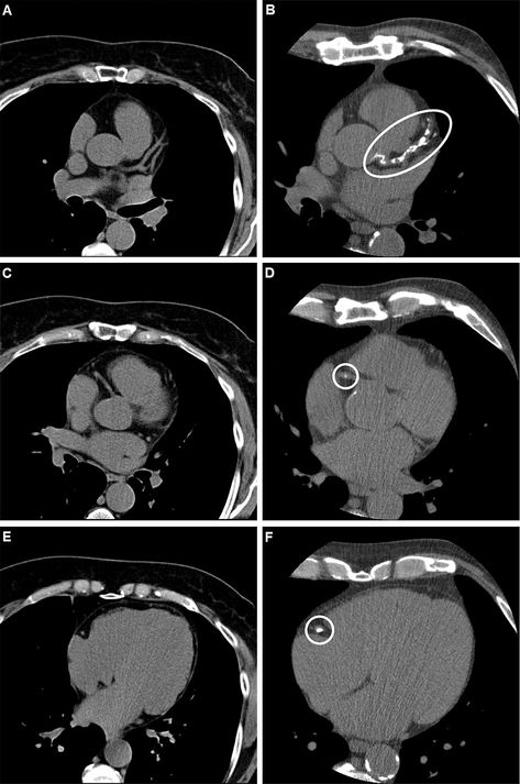 Study finds coronary artery calcium score is predictive of heart attacks, strokes Coronary Calcium Score, Percutaneous Coronary, Common Carotid Artery, Right Heart Catheterization Pressures, Coronary Angiography, Coronary Artery, Coronary Arteries, Ct Scan, Chest Pain