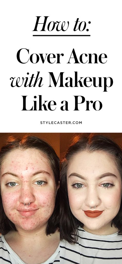 How to Cover Acne with Makeup (Like a Pro!) | This woman's before-and-after photo is living proof that you can flawlessly conceal even the worst breakouts | @stylecaster Cover Acne With Makeup, How To Cover Pimples, Acne With Makeup, Covering Acne With Makeup, Acne Concealer, Covering Acne, Lotion For Oily Skin, Acne Makeup, Tips For Oily Skin